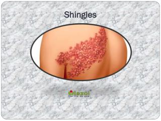 Shingles: Symptoms, Risk factors, Causes, Diagnosis and Treatment