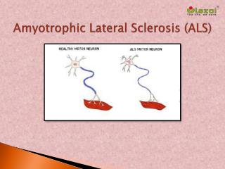 Amyotrophic Lateral Sclerosis (ALS): Symptoms, causes and treatment