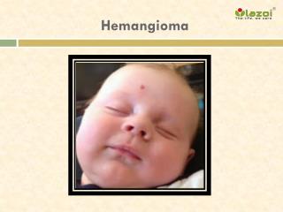 Hemangioma: Causes, Symptoms, Diagnosis and Treatment