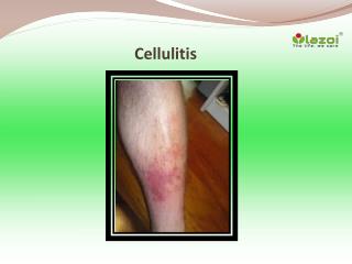 Cellulitis: Symptoms, Causes, Diagnosis, Treatment, Prevention and Complications