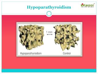 Hypoparathyroidism: Symptoms, Causes, Treatment and more