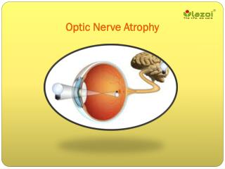 Optic Nerve Atrophy: A guide to symptoms, causes and treatment