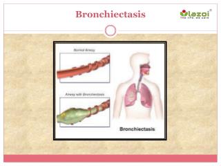 Meaning of bronchiectasis, symptoms, causes and what can be done