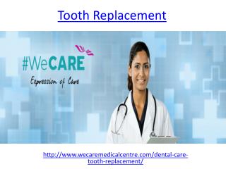 Affordable Tooth Replacement options in Dubai