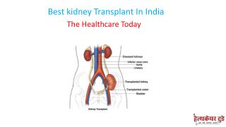 Best kidney Transplant In India