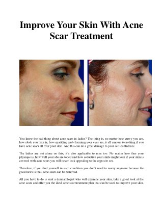 Improve Your Skin With Acne Scar Treatment