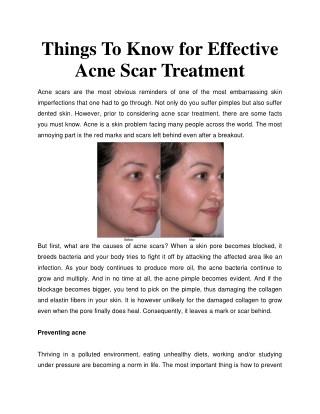 Things To Know for Effective Acne Scar Treatment