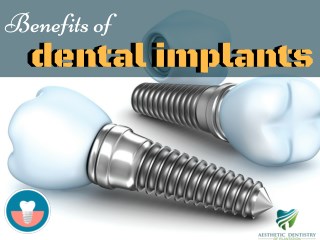 Dental Implants Services in Plantation Area