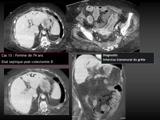 Cas 13 : Femme de 74 ans Etat septique post-colectomie D