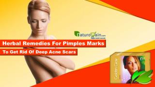 Herbal Remedies for Pimples Marks to Get Rid of Deep Acne Scars