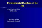 Developmental Dysplasia of the Hip