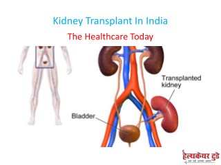 Kidney Transplant In India