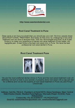 Root Canal Treatment in Pune - Sweet Smile Dental Clinic