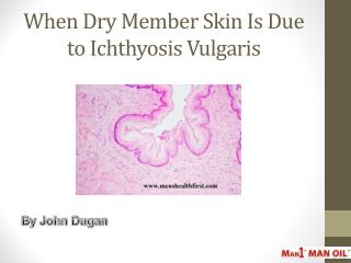 When Dry Member Skin Is Due to Ichthyosis Vulgaris