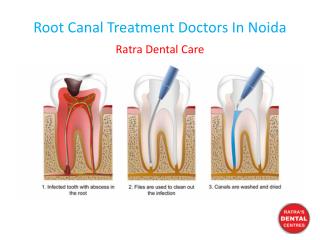 Root Canal Treatment Doctors In Noida