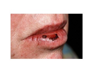 Cracked Lip Corners, Angular Cheilitis Treatment, Angular Cheilitis Home Remedies, Angular Cheilitis