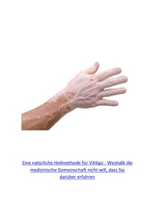 Pigmentflecken, Vitiligo Komplett Geheilt, Pigmentflecken Oberlippe, Vitiligo Heilung, Vitiligo