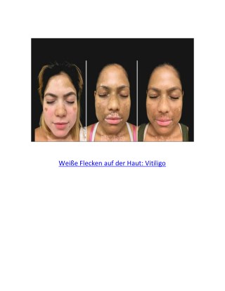 Hautpilz WeiÃŸe Flecken, WeiÃŸe Punkte Im Hals, Kleine WeiÃŸe Flecken Auf Der Haut, Was Ist Vitiligo