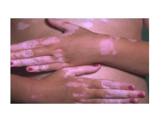 Protopic Vitiligo, WeiÃŸe Flecken Am RÃ¼cken, Pigmentflecken Im Gesicht Entfernen, Flecken Haut