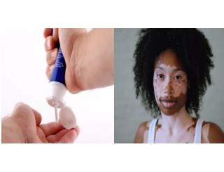 WeiÃŸe Punkte Auf Der Haut, Vitiligo Symptome, Vitiligo Behandlung, WeiÃŸe Flecken Haut Pilz