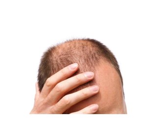 Laser Hair Regrowth, Alopecia Areata Hair Regrowth, Hair Regrowth Shampoo For Men