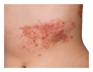 Is Shingles Contagious, What Are Shingles, Herpes Zoster Pictures, Shingles Home Remedies