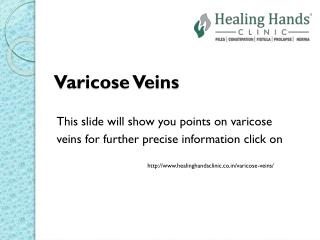 Varicose Veins causes, symptoms and treatment