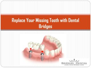 Brandon Dentist: Repalce Your Missing Tooth With Dental Bridges