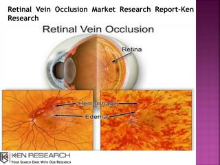 Retinal Vein Occlusion Market Opportunities-Ken Research