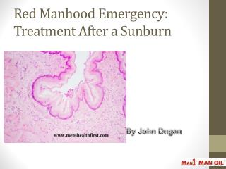 Red Manhood Emergency: Treatment After a Sunburn