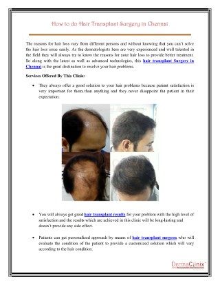 How to do Hair Transplant Surgery in Chennai