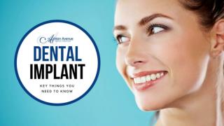 Key Things You Need to Know About Dental Implants