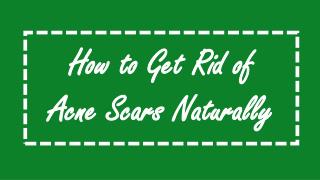 How to Get Rid of Acne Scars Naturally