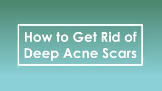 How to get Rid of Deep Acne Scars