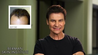 Hair Transplant in Palo Alto CA