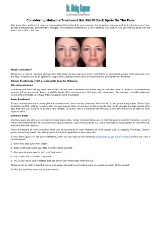 Considering Melasma Treatment Get Rid Of Dark Spots On The Face