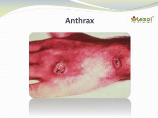 Anthrax