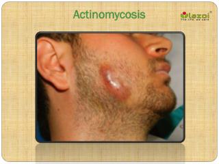 Actinomycosis