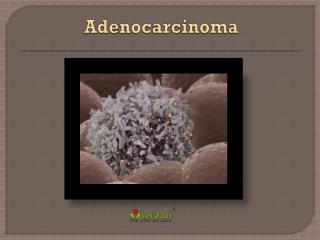 Adenocarcinoma