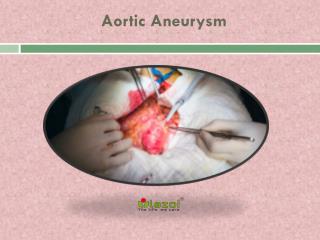 Aortic Aneurysm
