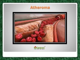 Atheroma
