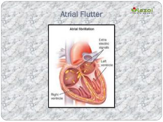 Atrial Flutter