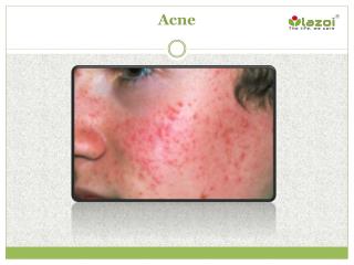 Acne