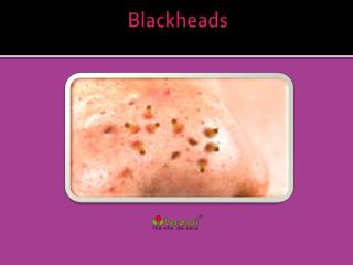 Blackheads