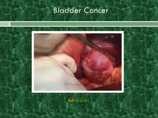 Bladder Cancer