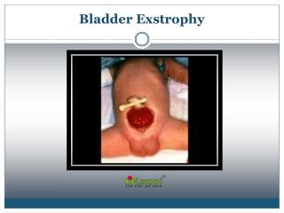 Bladder Exstrophy