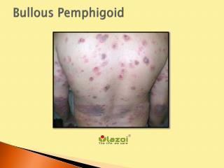 Bullous Pemphigoid
