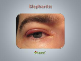 Blepharitis