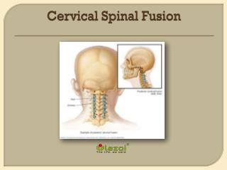 Cervical Spinal Fusion