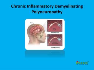 Chronic Inflammatory Demyelinating Polyneuropathy